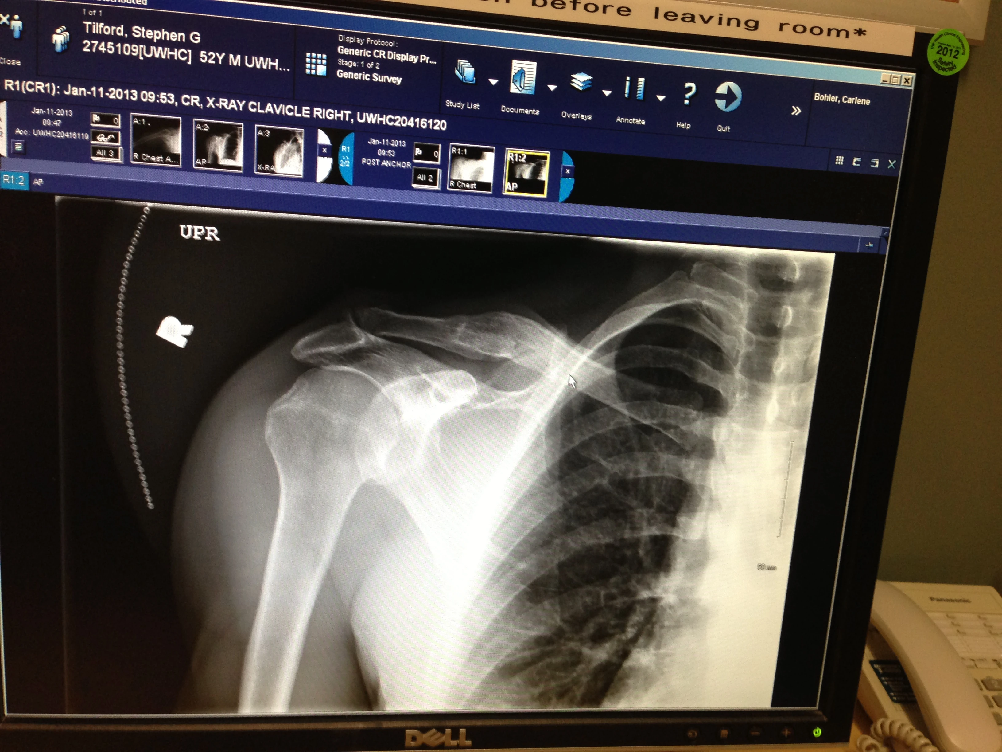 My x-ray. But, I needed a MRI to show the damage.