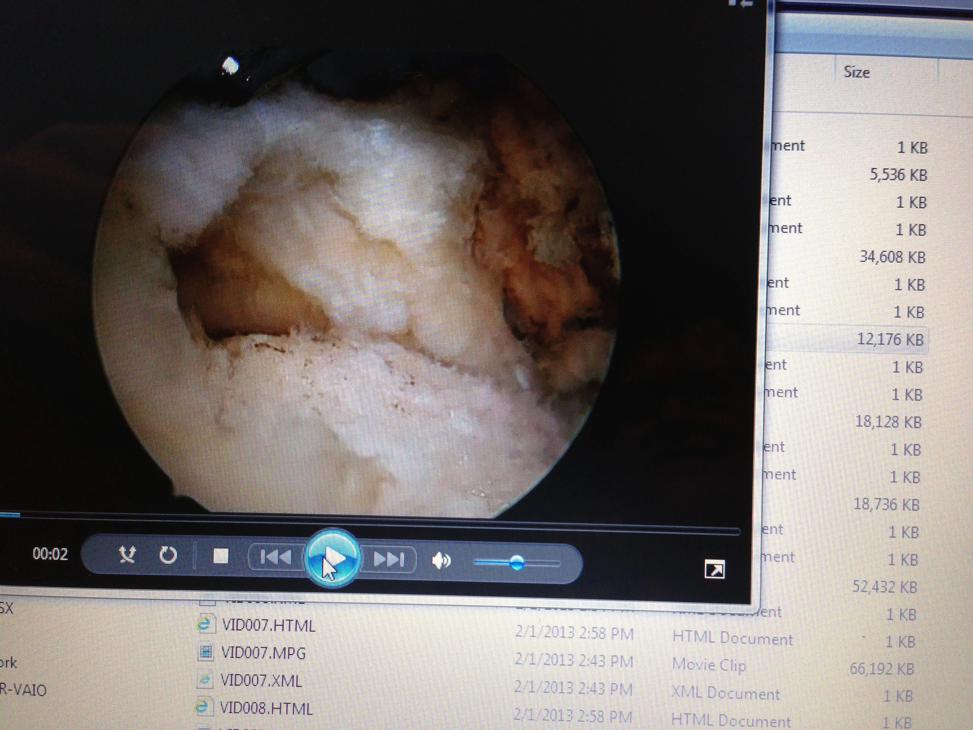 This is a photo that I took of a rotatorcuff surgery that Stacey did. I got a little queasy watching the screws go into the bone. Might of not been such a good idea after the fact.