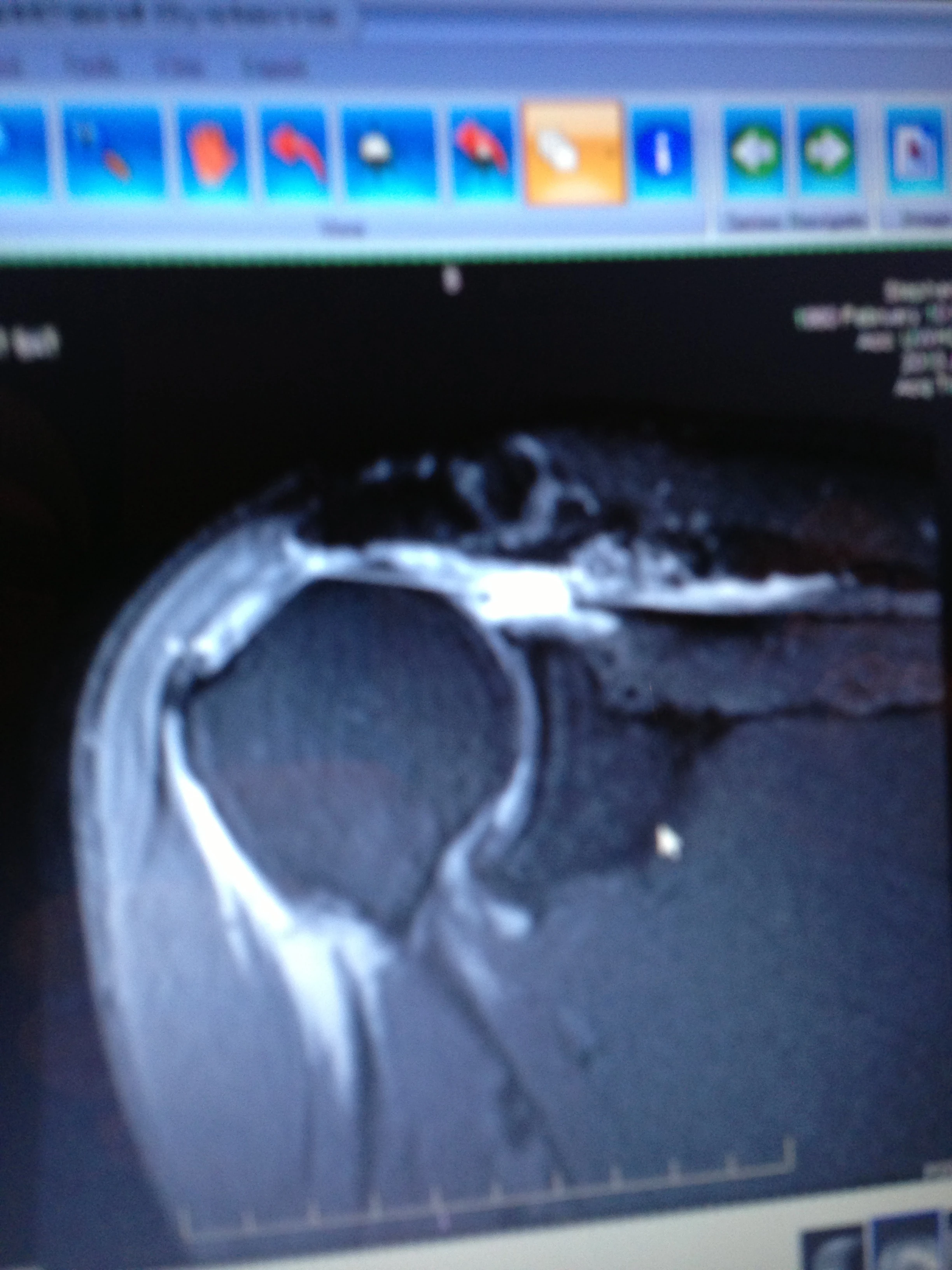 This is a MRI of my shoulder. I have two completely torn tendons, one retracted 6.7 cm and the other 3.9 cm. Not a good thing.