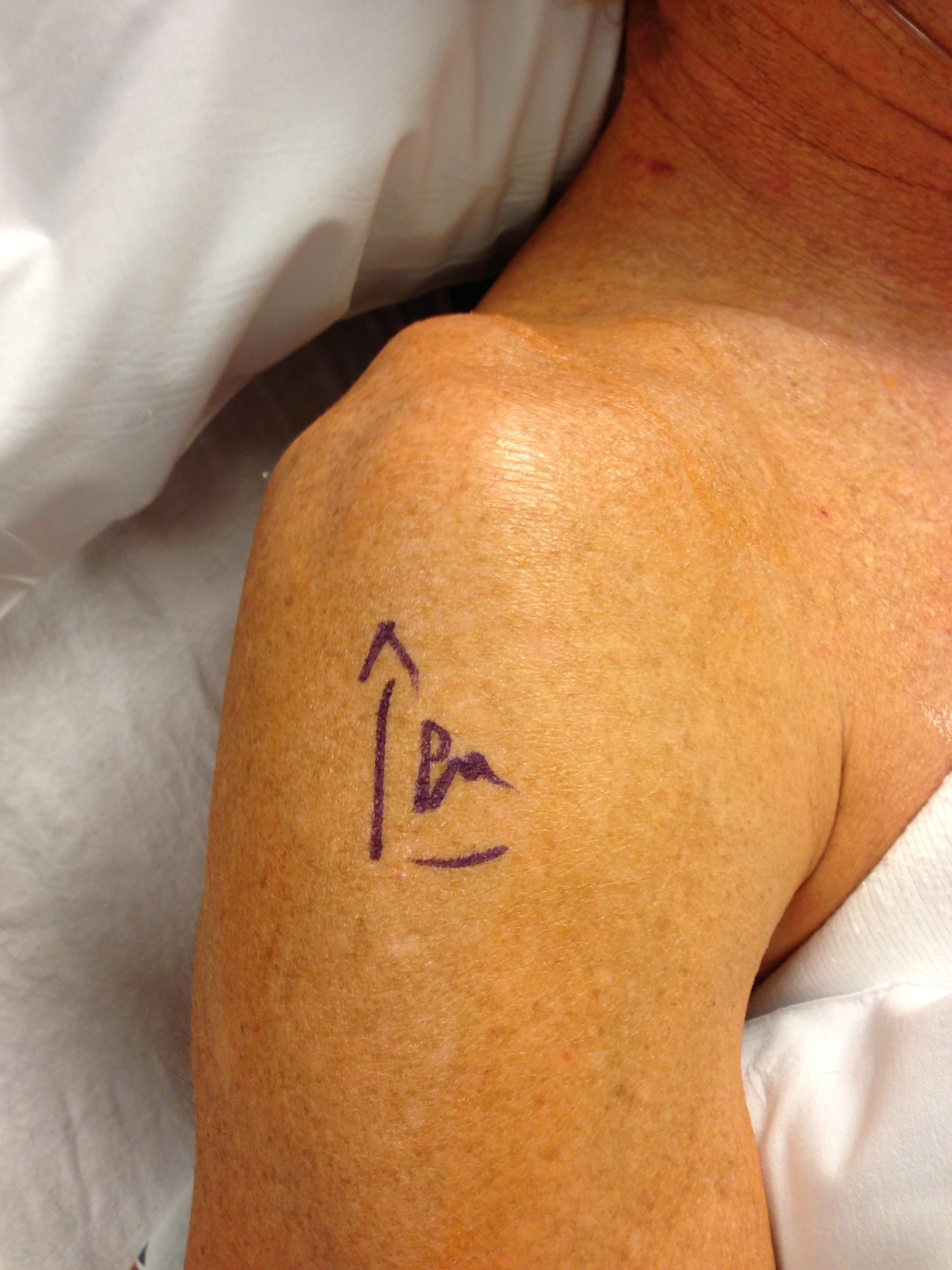 The doctor came by and marked the correct arm to operate on. That lowered my confidence level just a tad. They had already shaved all the surrounding area, including my armpit. The nurse apologized about being a little rough and said something about knowing how weird it must feel. I told her I did it all the time, so no worries.