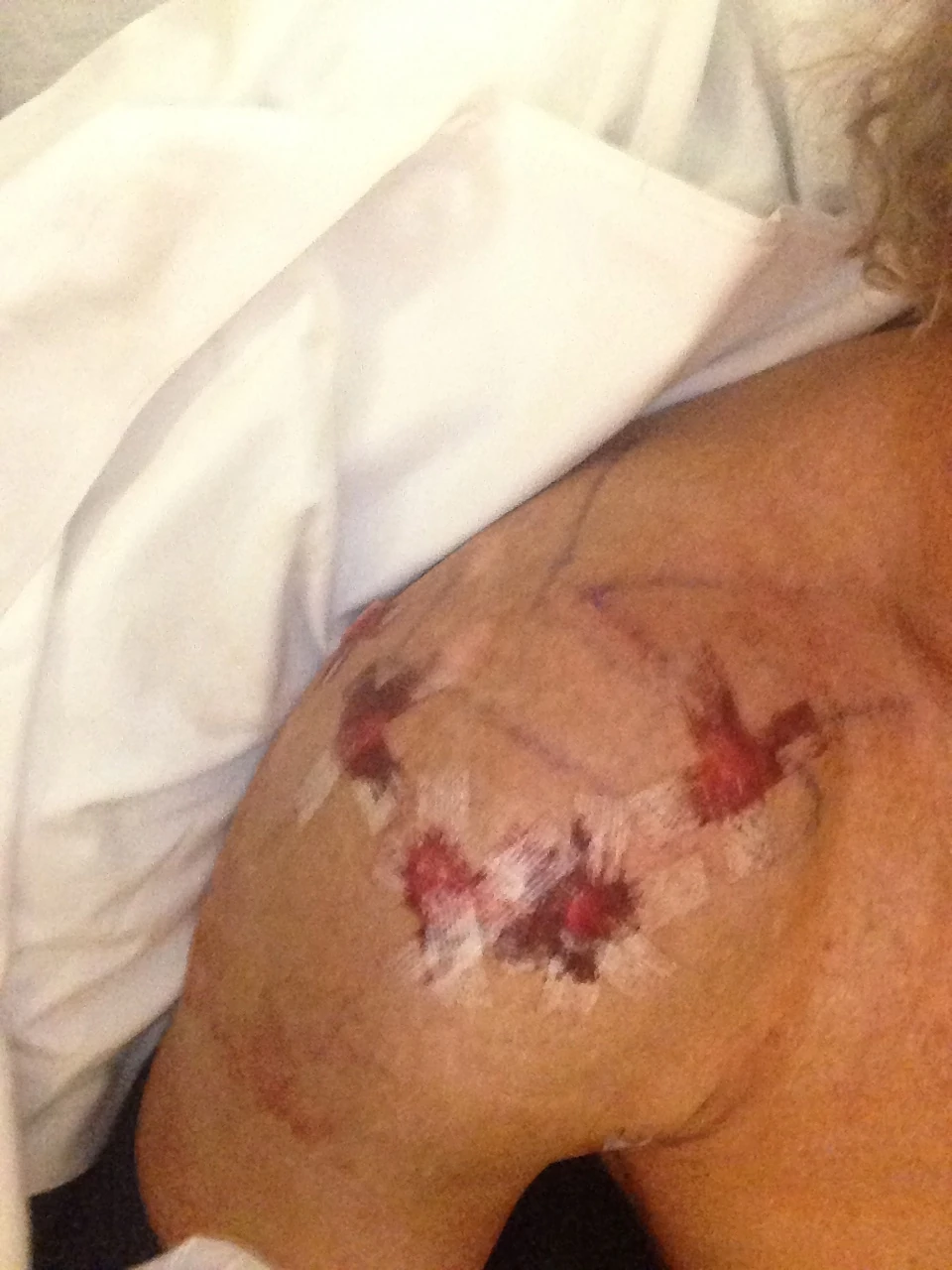 Changing the dressing yesterday.