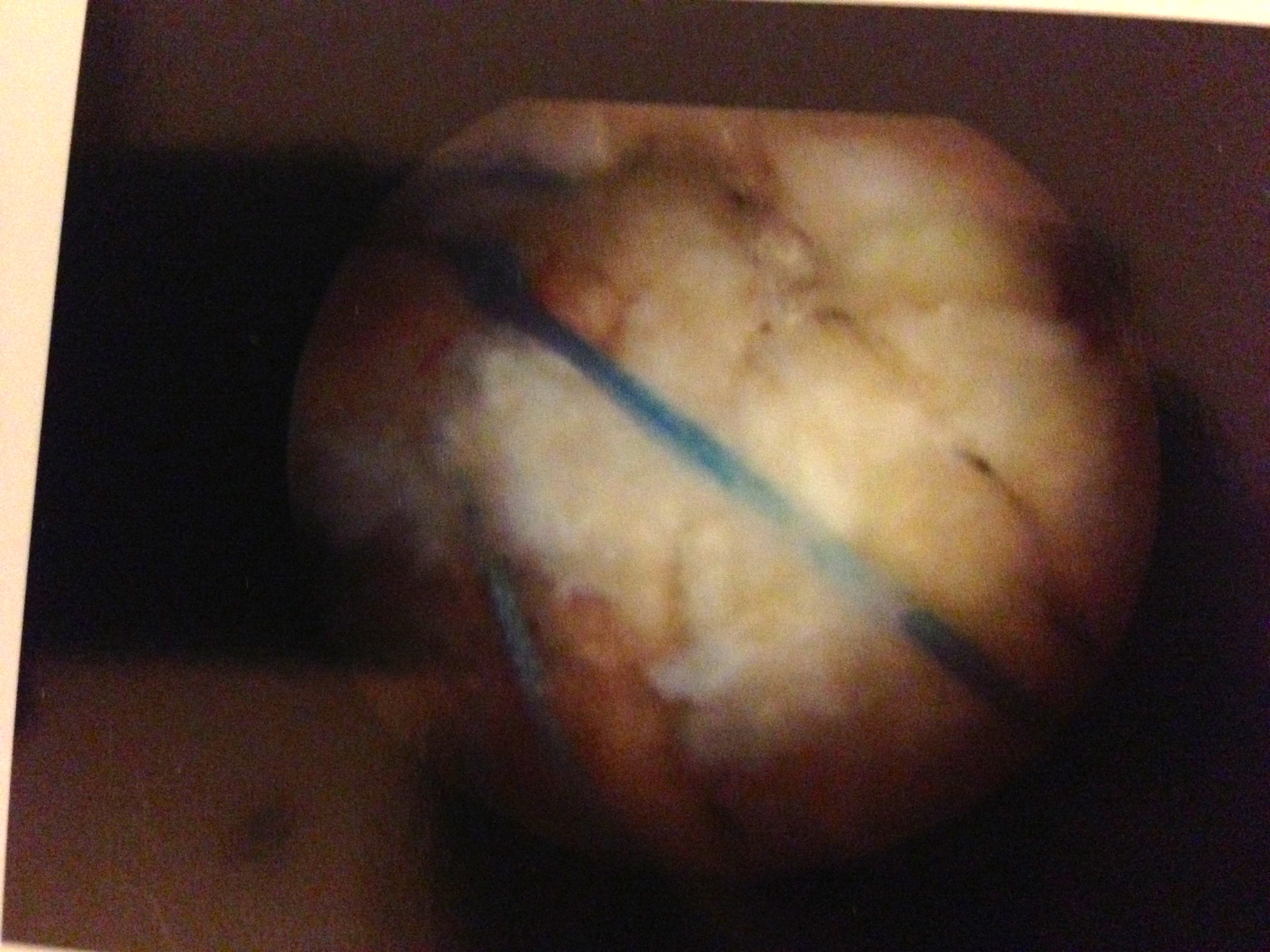 Here is the finished product. There are some anchors screwed into the Humerus, holding the sutures in place.