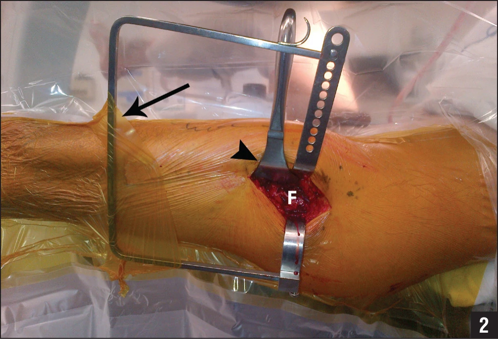 This is it in use. No wonder my IT band feels like a solid rock.