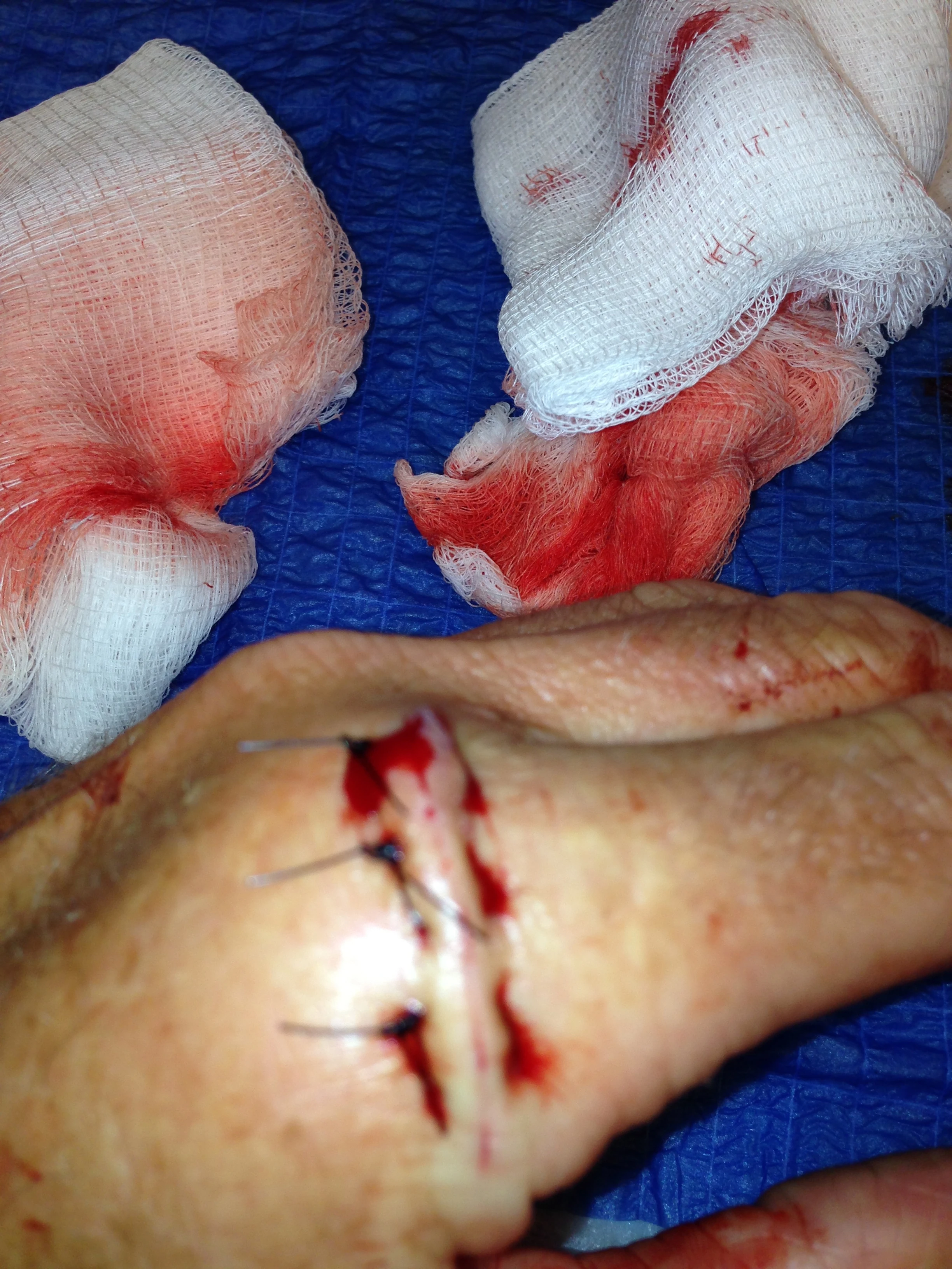 After repair, it started swelling up pretty big.