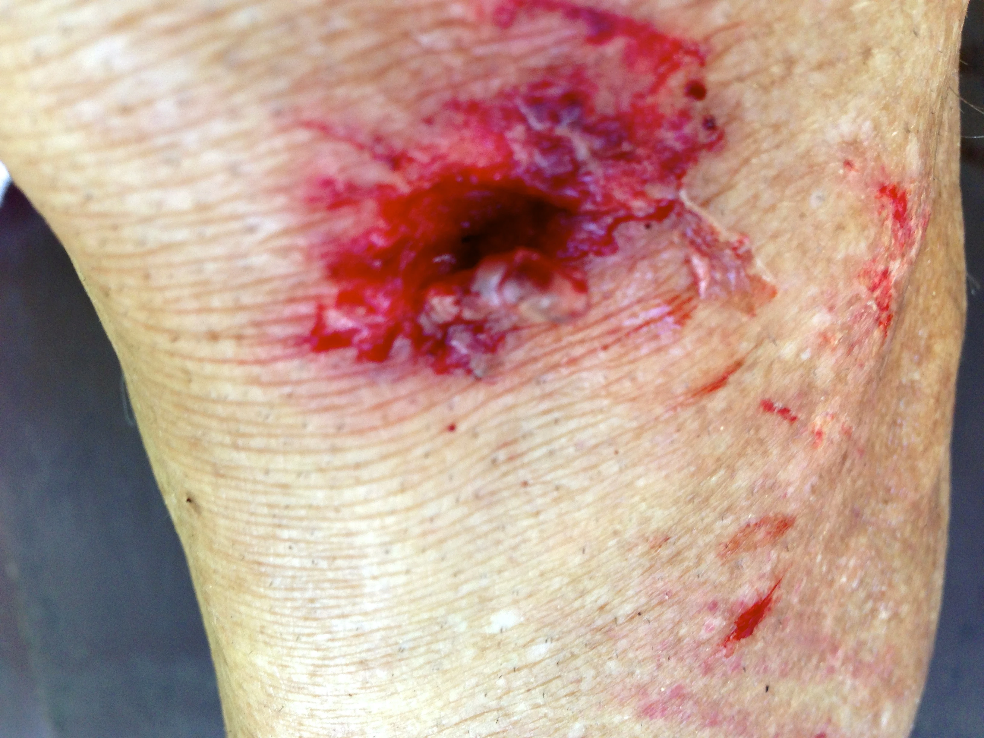 My knee after the race. I probably should have put a couple stiches in, but didn&rsquo;t have any with me and didn&rsquo;t feel much like the whole hospital ordeal. I wonder what it looks like today, under the bandage?