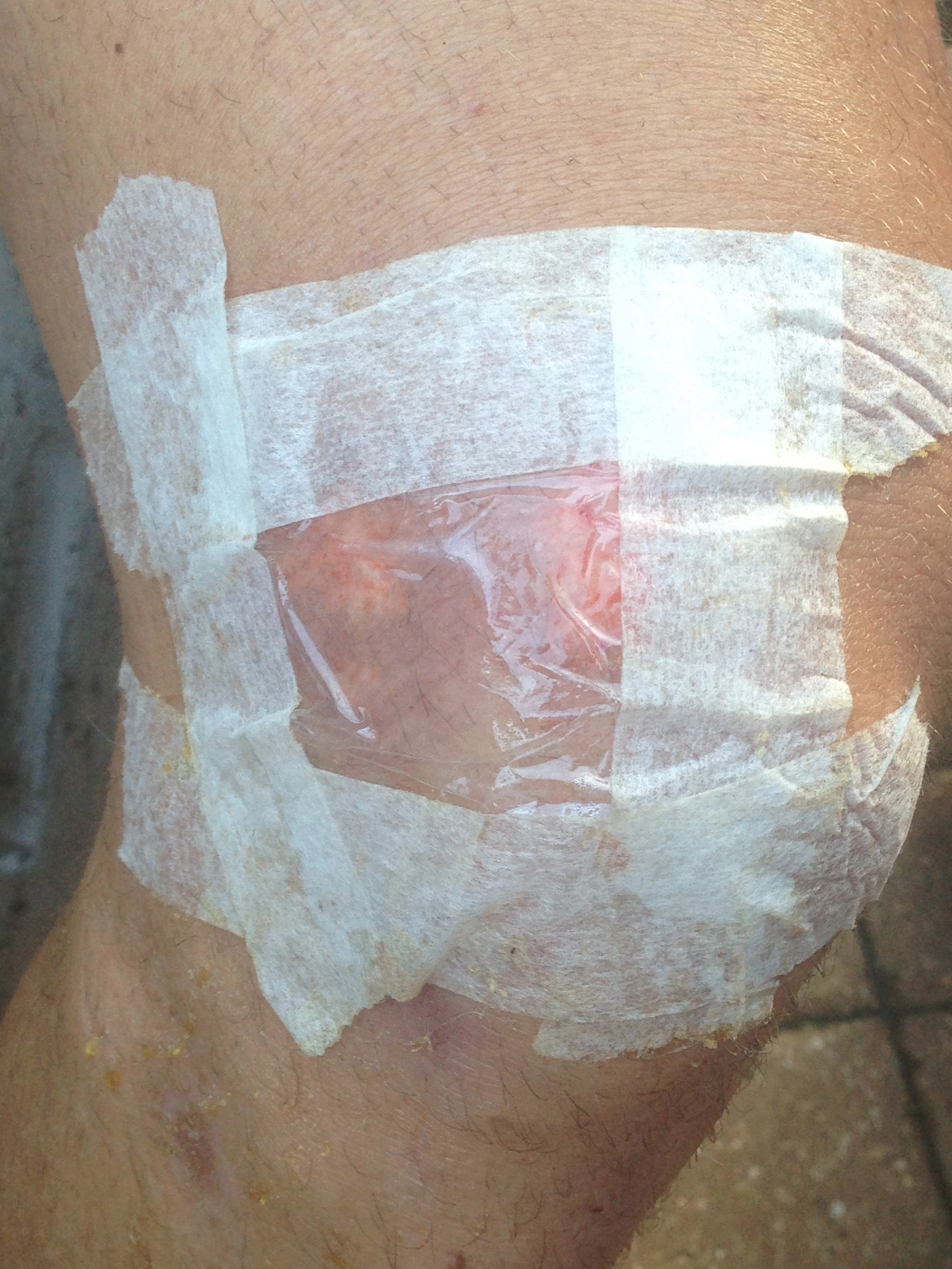 Bill has already lowered his standards by making his own Tegaderm with a plastic wrap and paper tape.