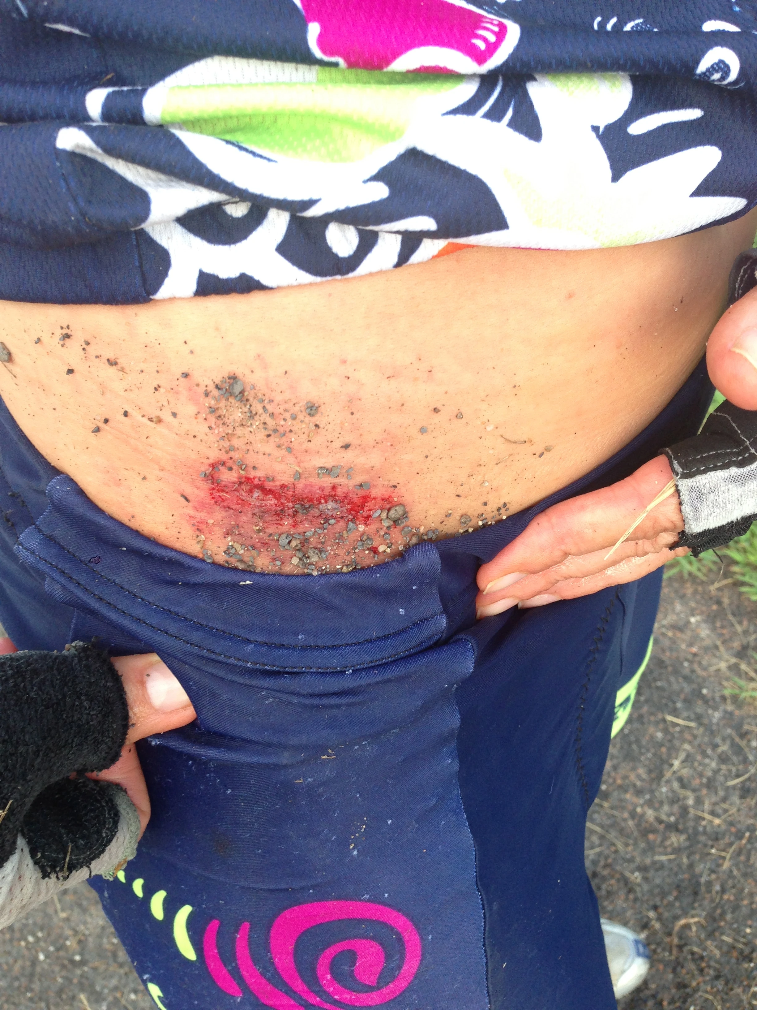 Just some of the damage on Catherine. It&rsquo;s her birthday today, so it was lucky she fell yesterday and got it out of the way.