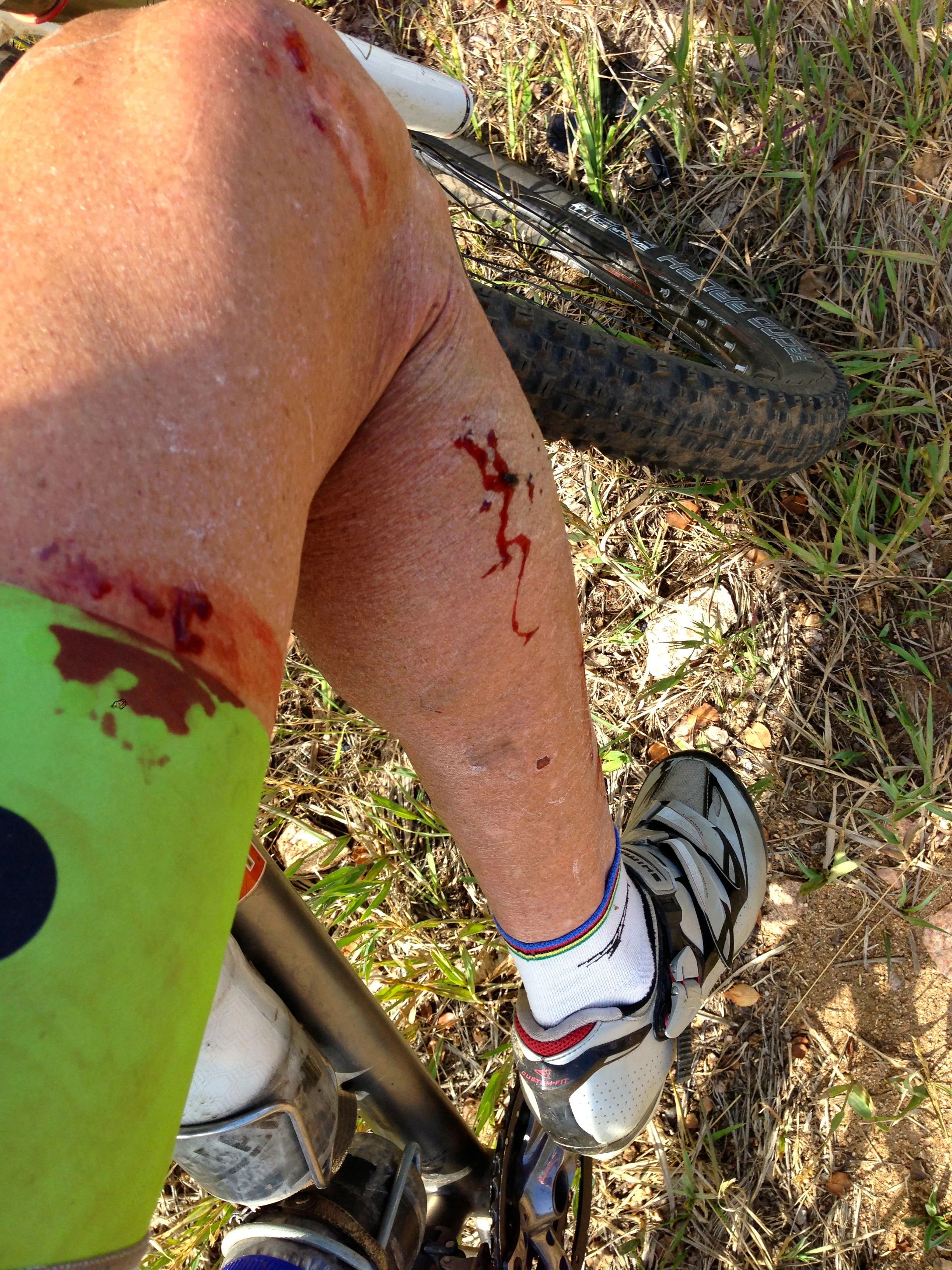 Not much blood after the fall. My upper back and shoulders took the brunt of it.