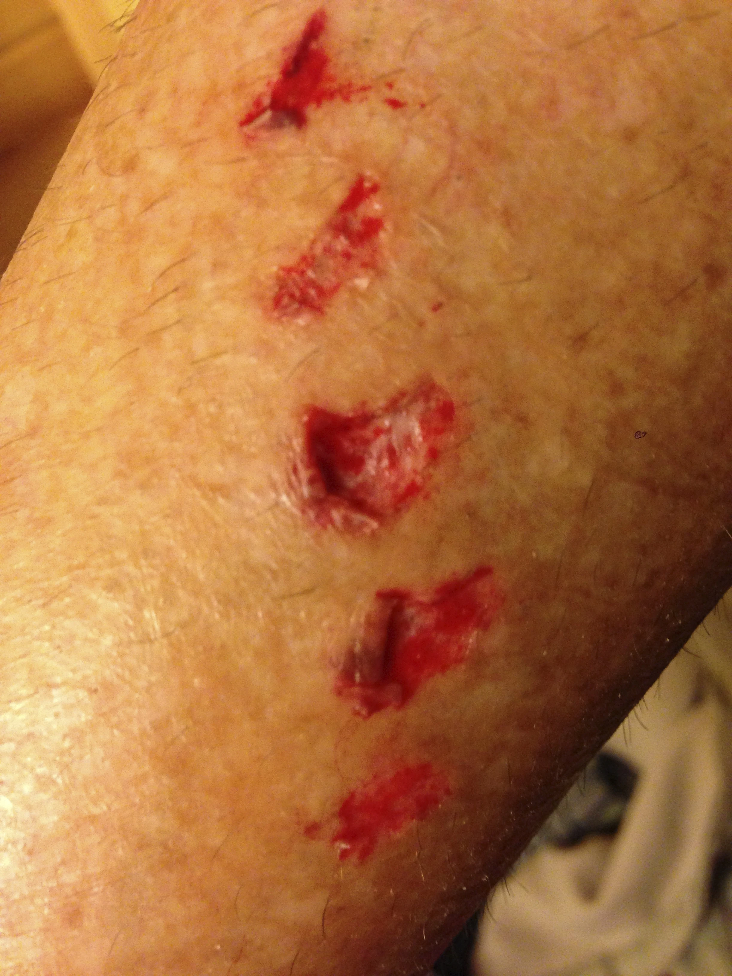 I fell on a slick root riding down to swim in the lake. Obviously my chainring caught my calf. I have this exact &ldquo;tatoo&rdquo; under my hair by getting ran over in a Gant Challenge race back in the 80&rsquo;s.