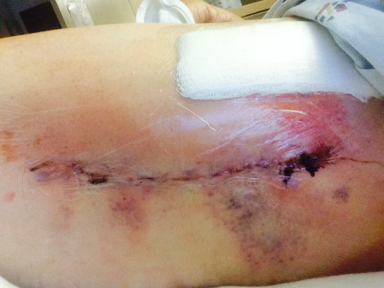 Little gory looking. I didn’t think the incision would be so huge.