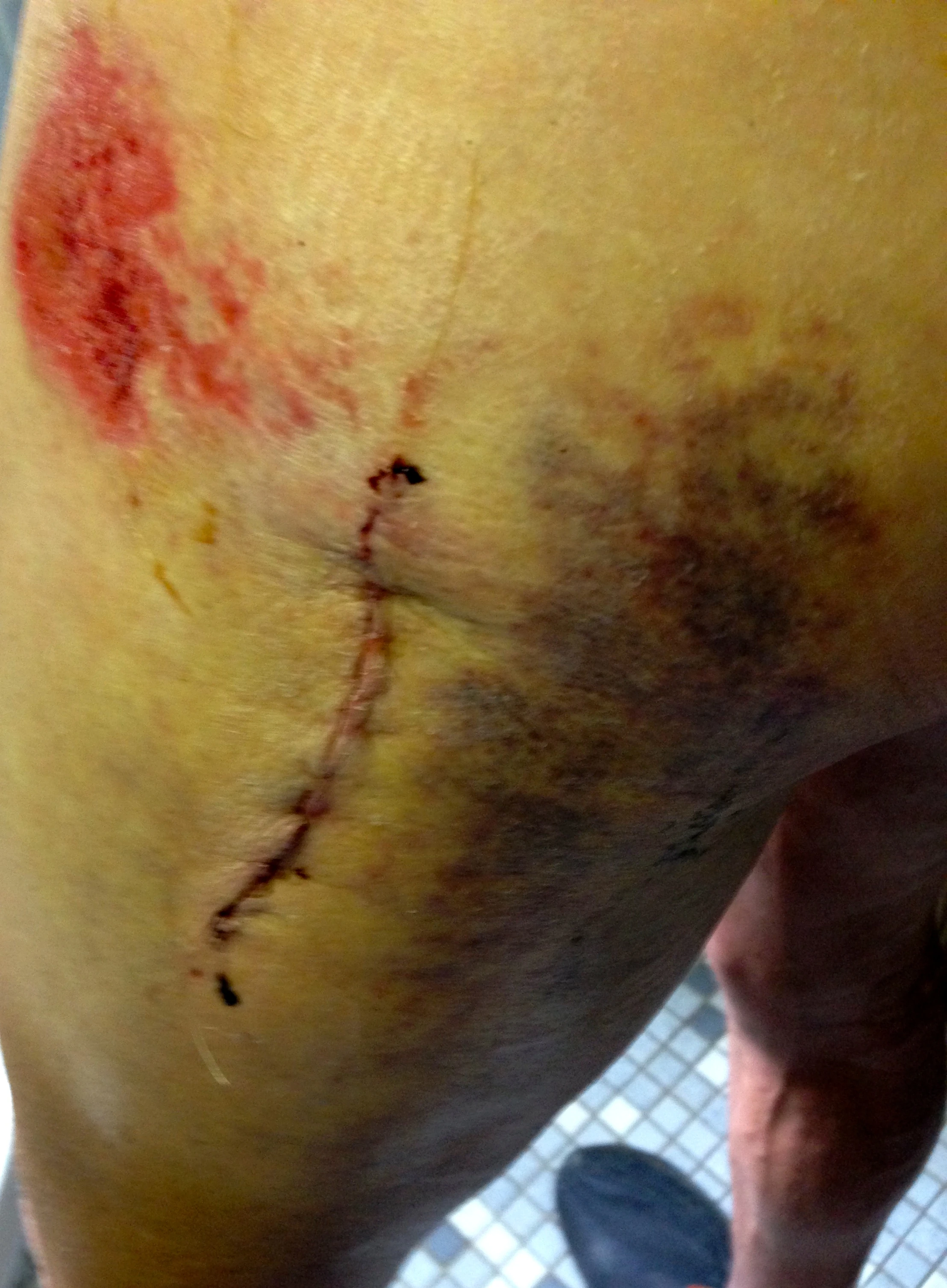 Butt still looks terrible, but seems to be healing up alright.