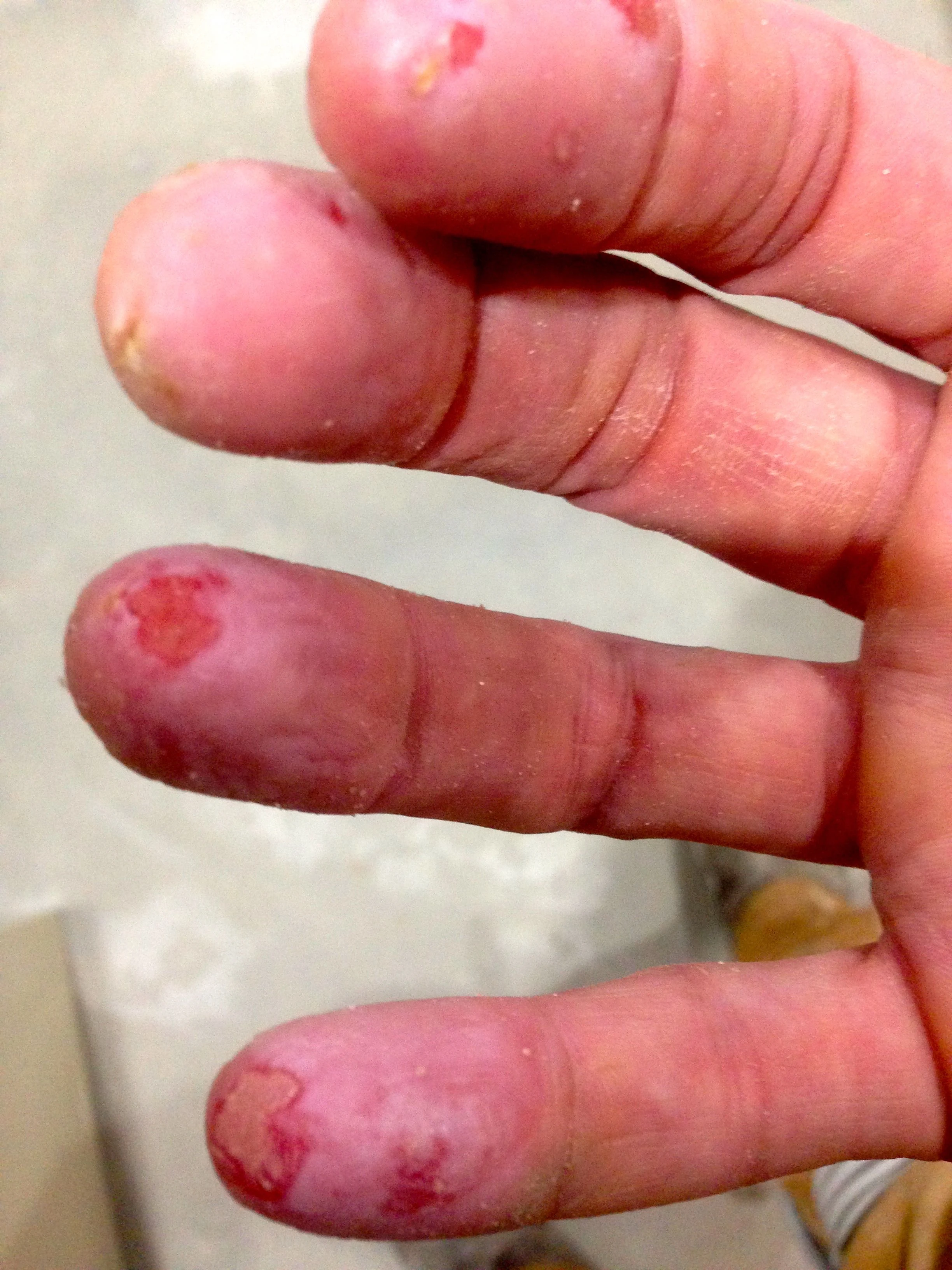 The picture was from yesterday. Today my fingers look much worse.