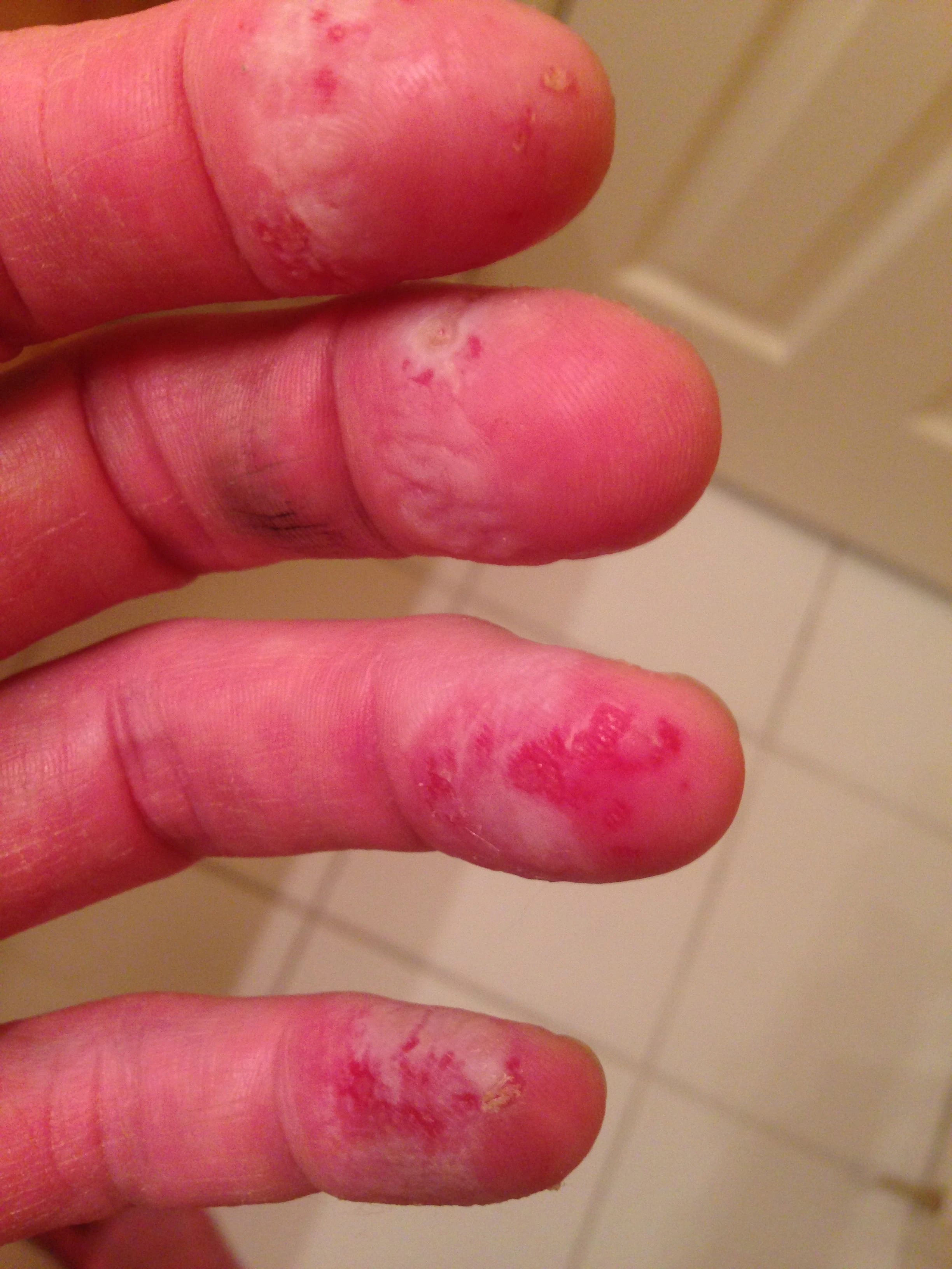 I&rsquo;m essentially valueless with my fingers destroyed. There are a lot of nerve ends in fingers, I&rsquo;ve learned.