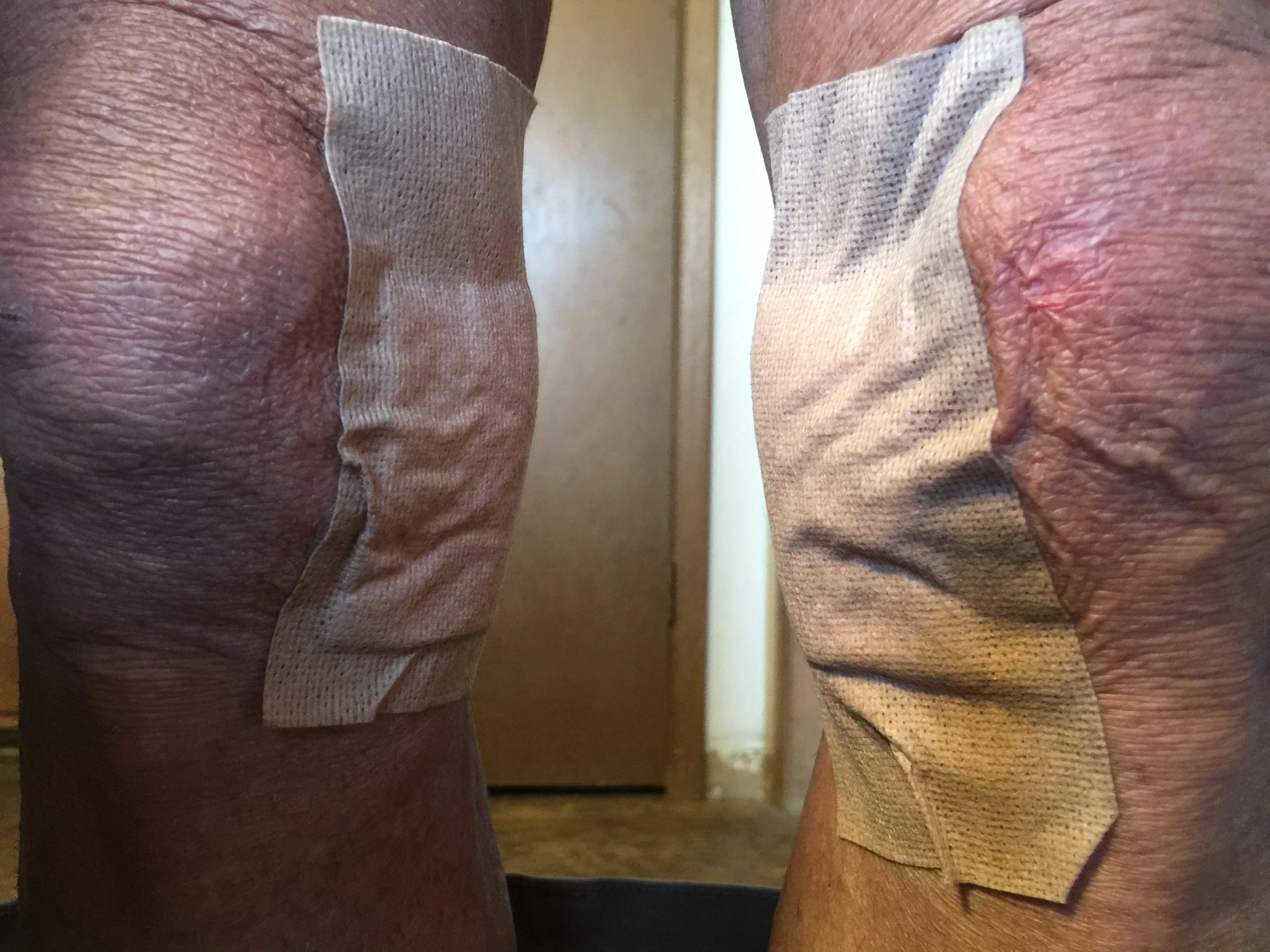 My knees this morning.