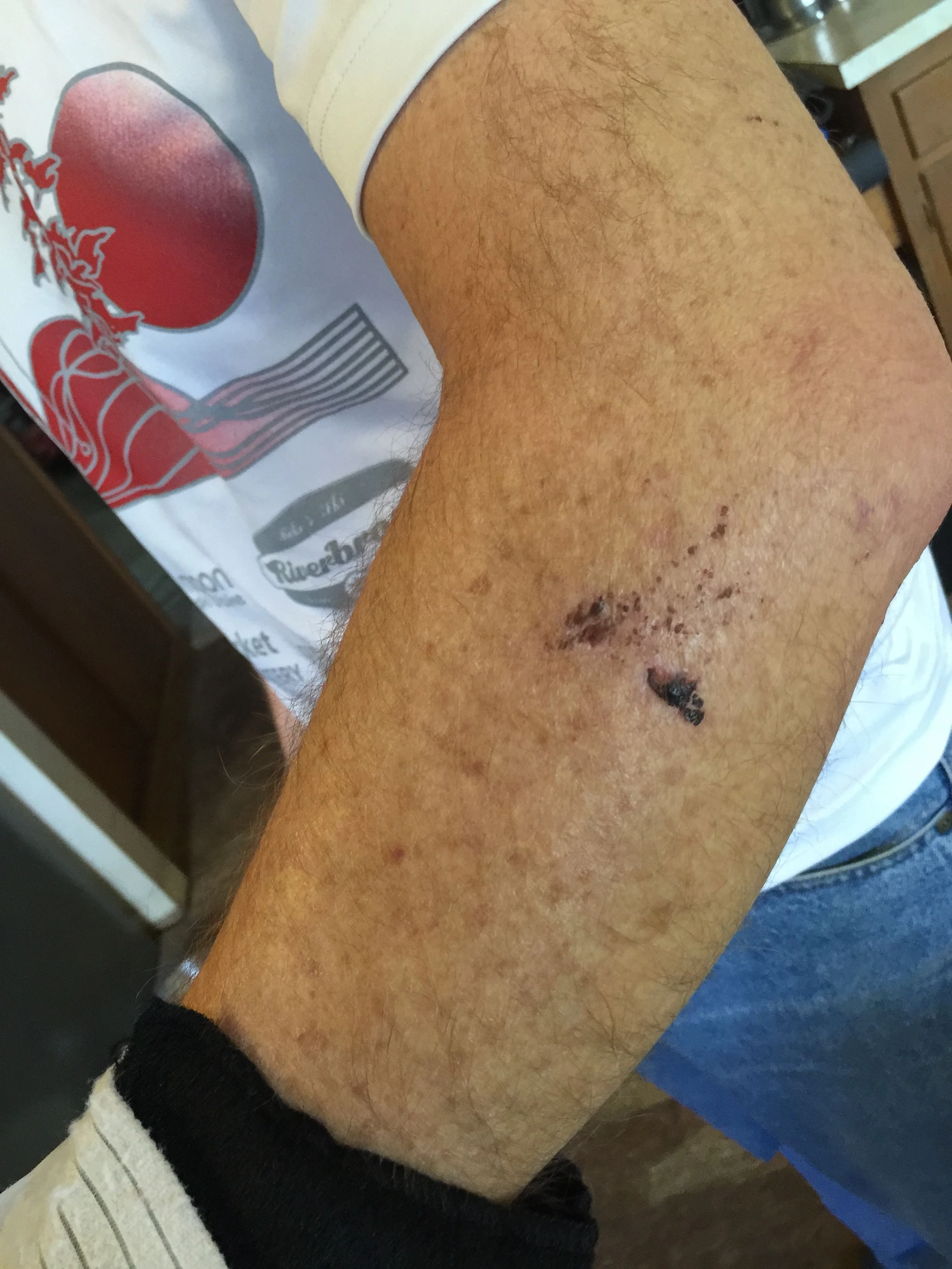 Dennis&rsquo; arm isn&rsquo;t getting any smaller. He hopes it will be deflated after the surgery today.