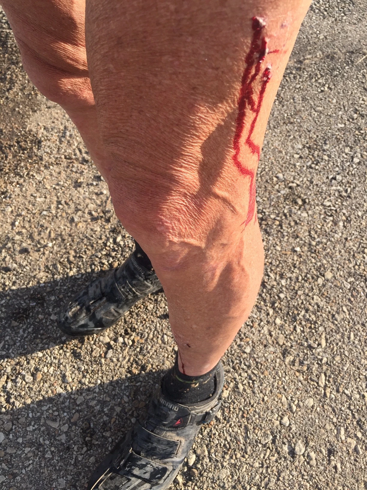 I was bleeding, just a bit, in quite a few places.