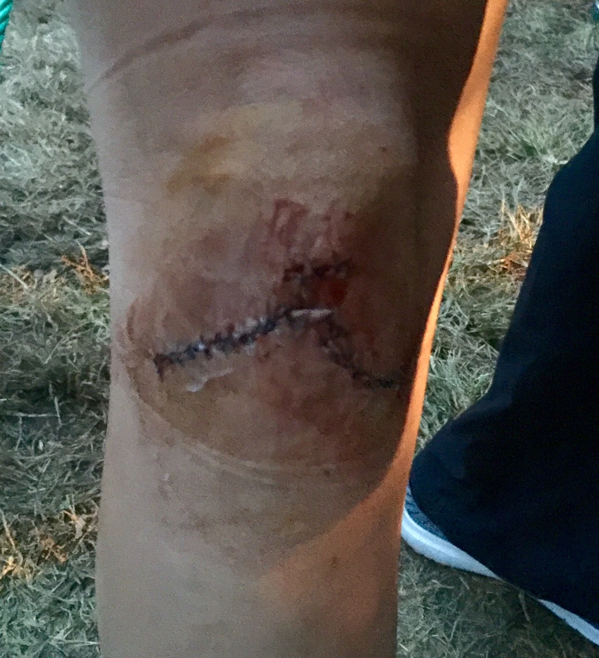 This is Leah Kleager&rsquo;s knee after her becoming up close and personal with the Berryman rocks. She had something like 40 stitches. She was in super good spirits and was bummed she didn&rsquo;t finish. Next year.