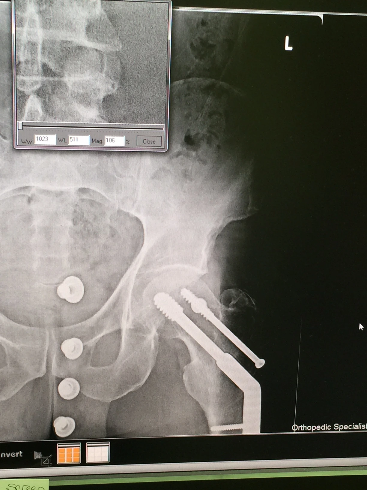 Hip looks good. Buttons of my jeans are the dots.