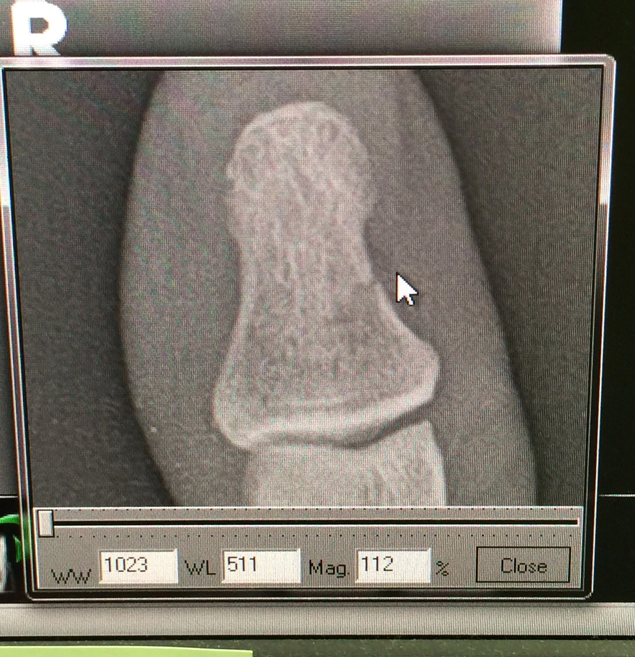 Broken thumb. Little hard to see the break in this picture, but it is pretty broke.