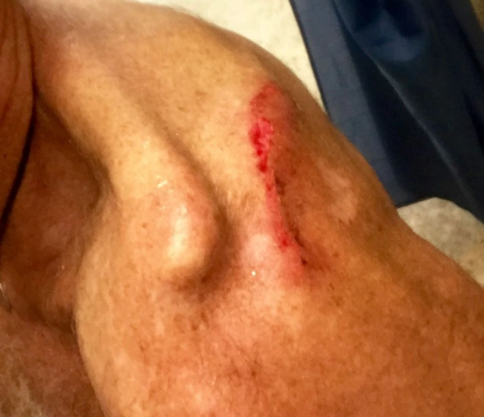 My shoulder after the race Saturday. It was much more swollen on Sunday morning.