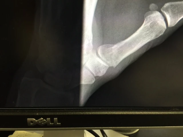 My left thumb is just a little displaced after my crankarm breakage fiasco.