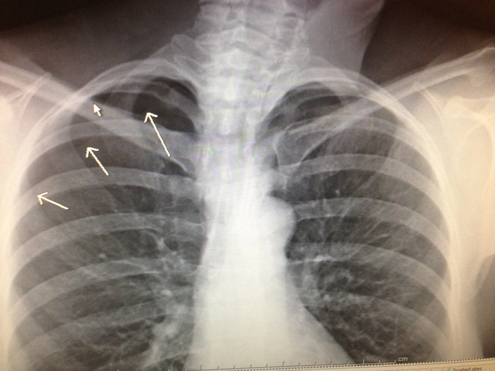 Catherine&rsquo;s x-ray. 