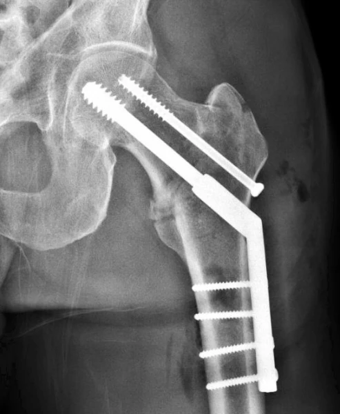 Original x-ray.