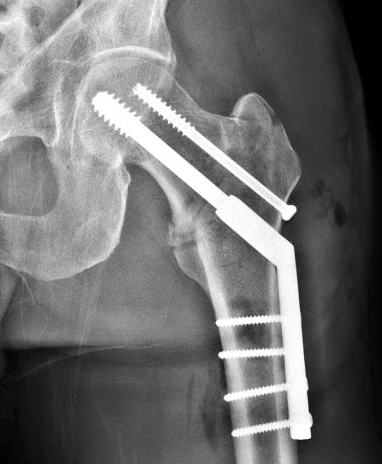 I&rsquo;m hopefully going to get another x-ray today or tomorrow to see how this is healing. It&rsquo;s been 8 weeks now.