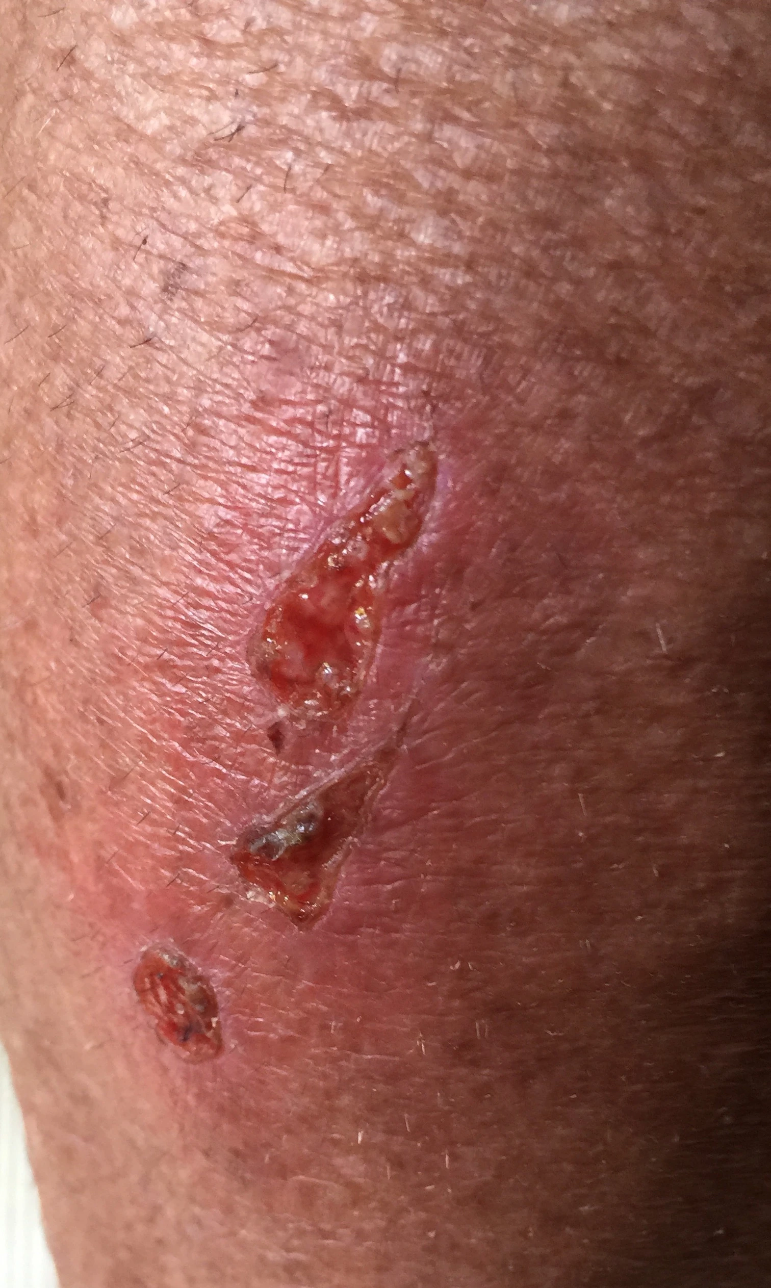 My calf has become a little infected after a crash before the Lutsen race last weekend. Maybe this is why I&rsquo;m feeling under the weather.