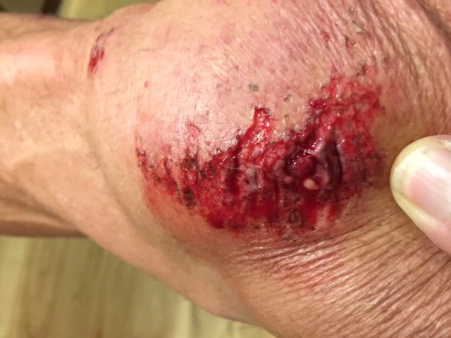 After scrubbing, pre-stitching.